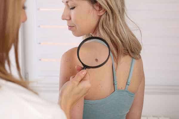 What Are Traditional Skin Lesion Removal Methods Wembley?