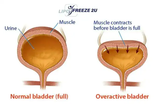 diagram of overactive bladder treatment Wembley