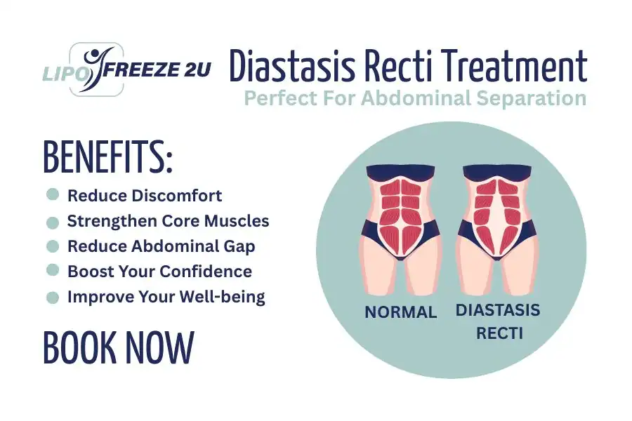 Benefits of body toning treatment Wembley for Diastasis recti