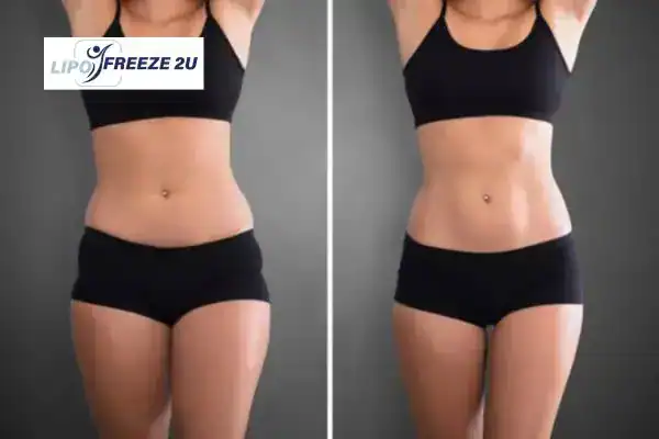 How Can LIPO FREEZE 2U Support Your Post-Pregnancy Body Recovery Wembley?