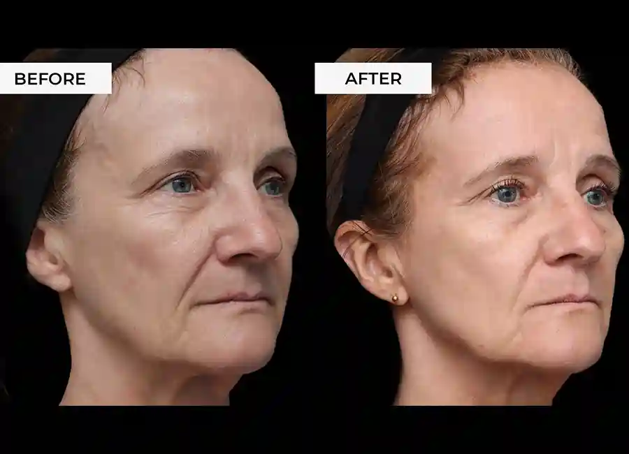 How Many RF Microneedling Sessions Will You Need to See a Difference Wembley?