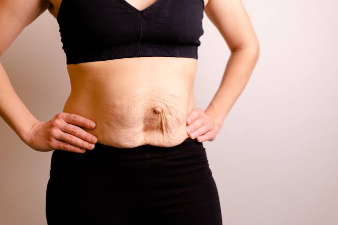 Is Surgery Really the Only Way to Repair Diastasis Recti Wembley?