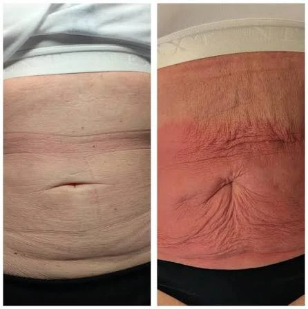 How Does RF Microneedling Improve Crepey, Thin and Uneven Skin Texture Wembley?