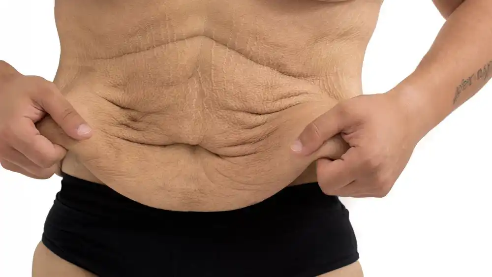 Why Does Weight Loss Medication Leave Some People With Loose or Sagging Skin Wembley?